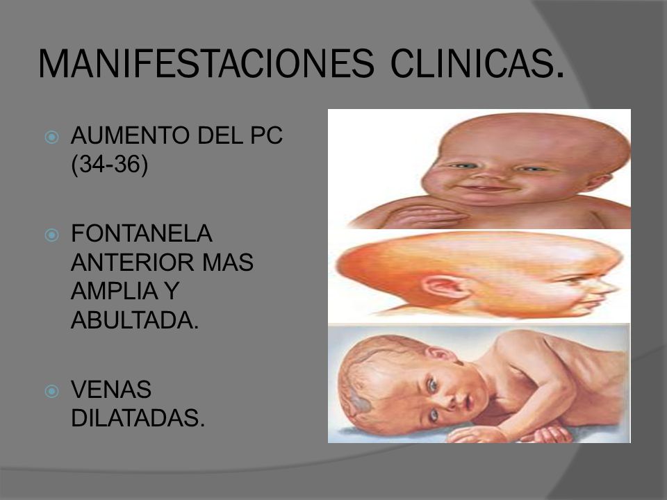 Abultada fontanela para la hipertensión Abultada fontanela para la hipertensión